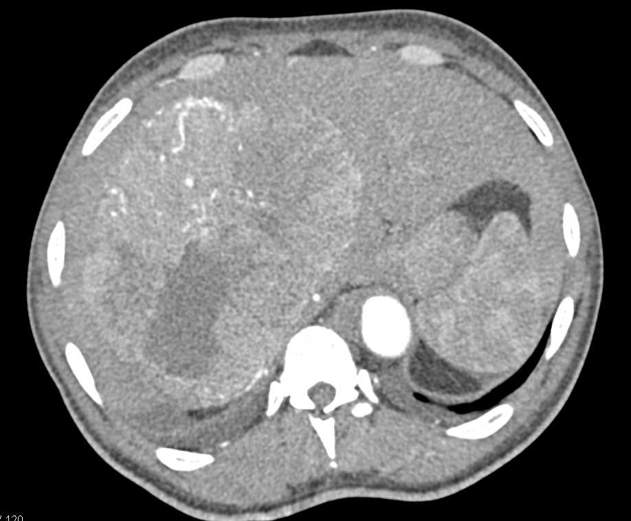 Hepatocellular Carcinoma (Hepatoma) with Neovascularity - CTisus CT Scan