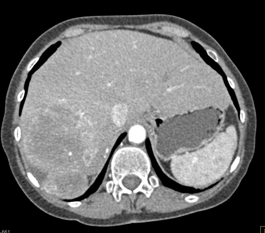 Multifocal Hepatocellular Carcinoma (Hepatoma) with Neovascularity - CTisus CT Scan