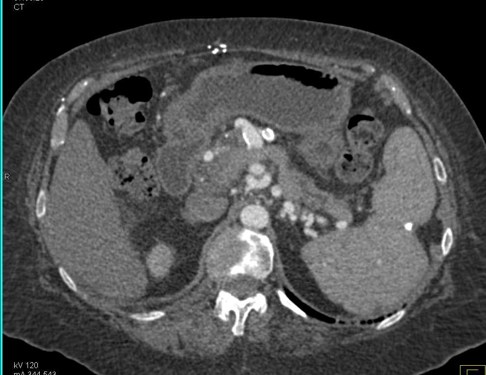 Portal Hypertension and Splenic Infarcts - CTisus CT Scan