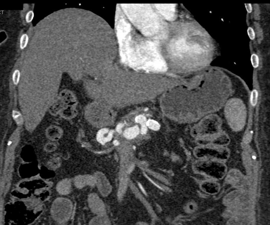 Portal Hypertension and Splenic Infarcts and Mesenteric Aneurysms - CTisus CT Scan