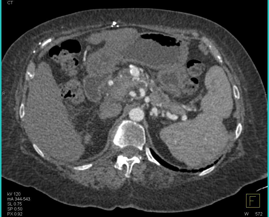 Portal Hypertension and Splenic Infarcts and Mesenteric Aneurysms - CTisus CT Scan