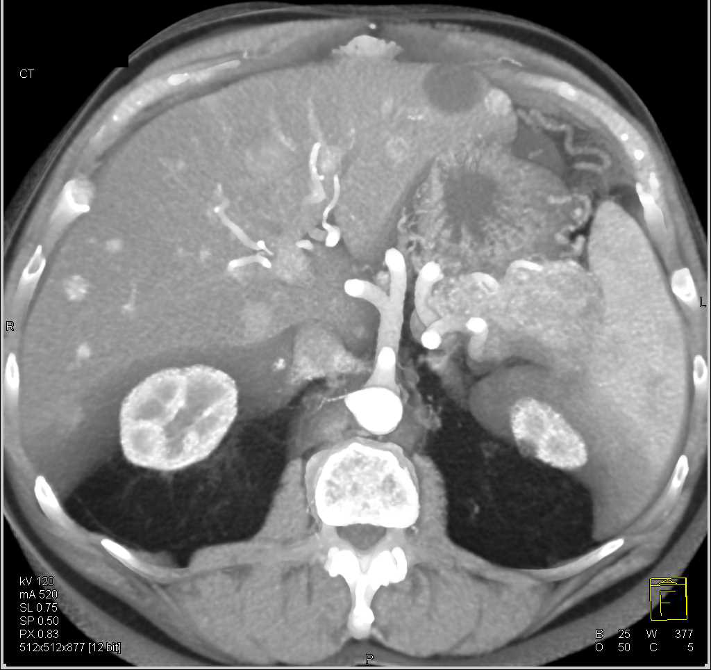 Neuroendocrine Tumor Tail Of Pancreas With Liver Metastases Liver