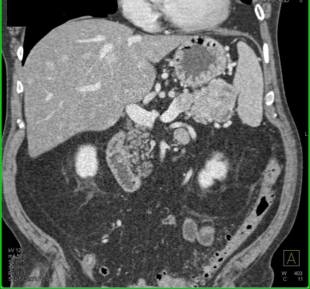 Neuroendocrine Tumor Tail of Pancreas with Liver Metastases - CTisus CT Scan