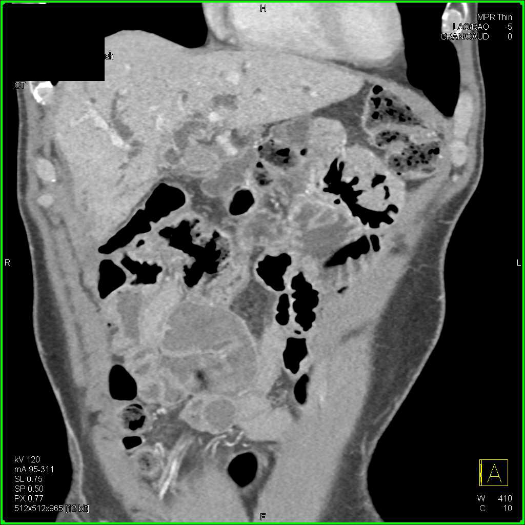 Distal Common Bile Duct Carcinoma - CTisus CT Scan