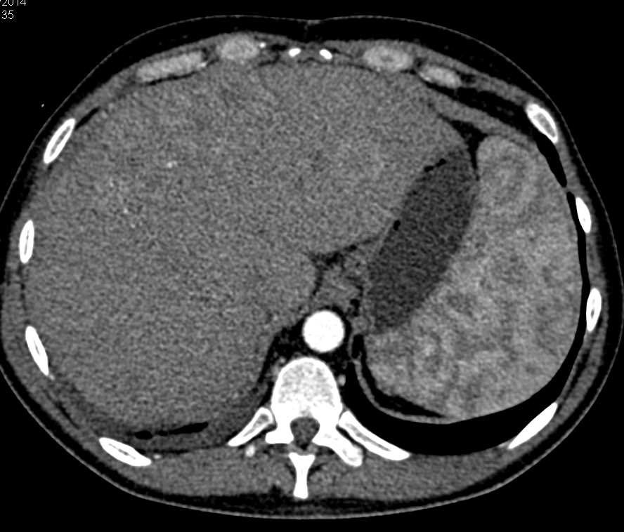 Lymphoma Involves the Liver - CTisus CT Scan