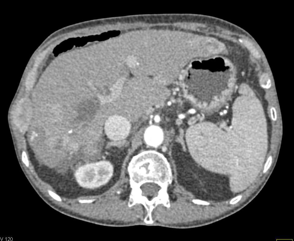 Calcifications in Hepatocellular Carcinoma (Hepatoma) - CTisus CT Scan