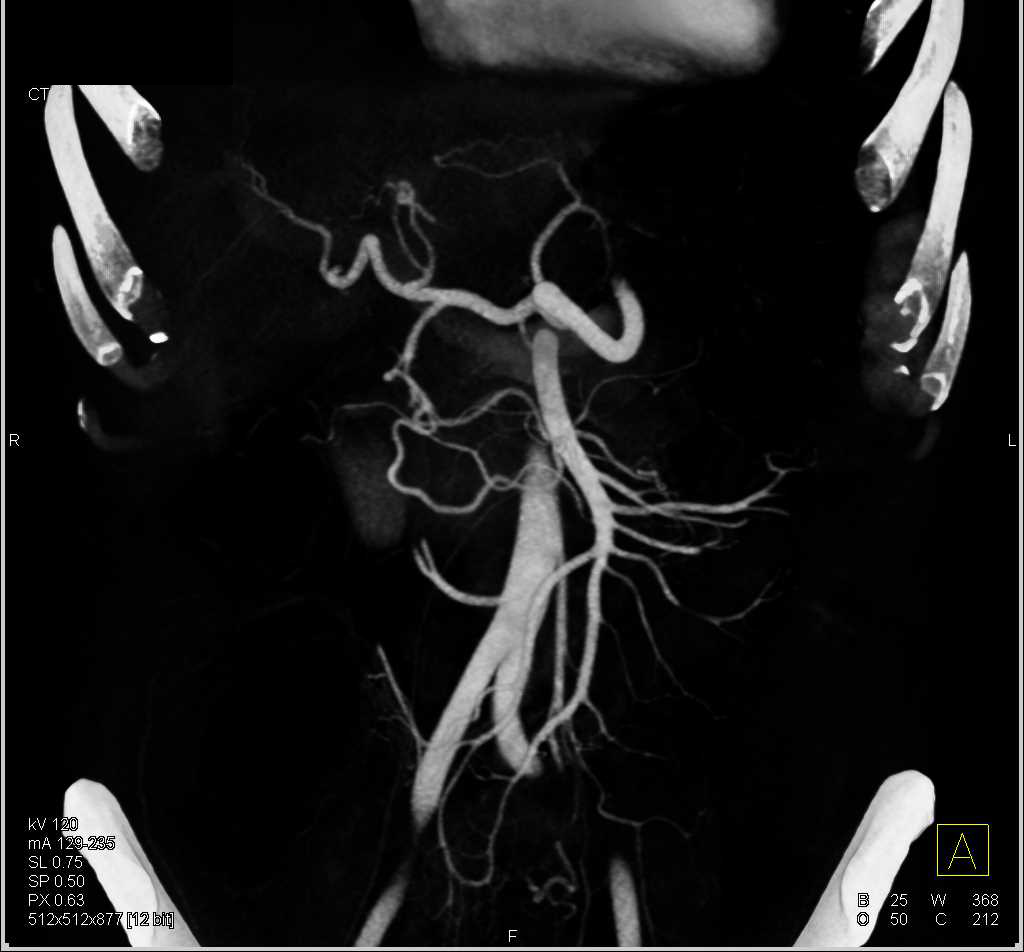 Multiple Liver Abscesses - CTisus CT Scan