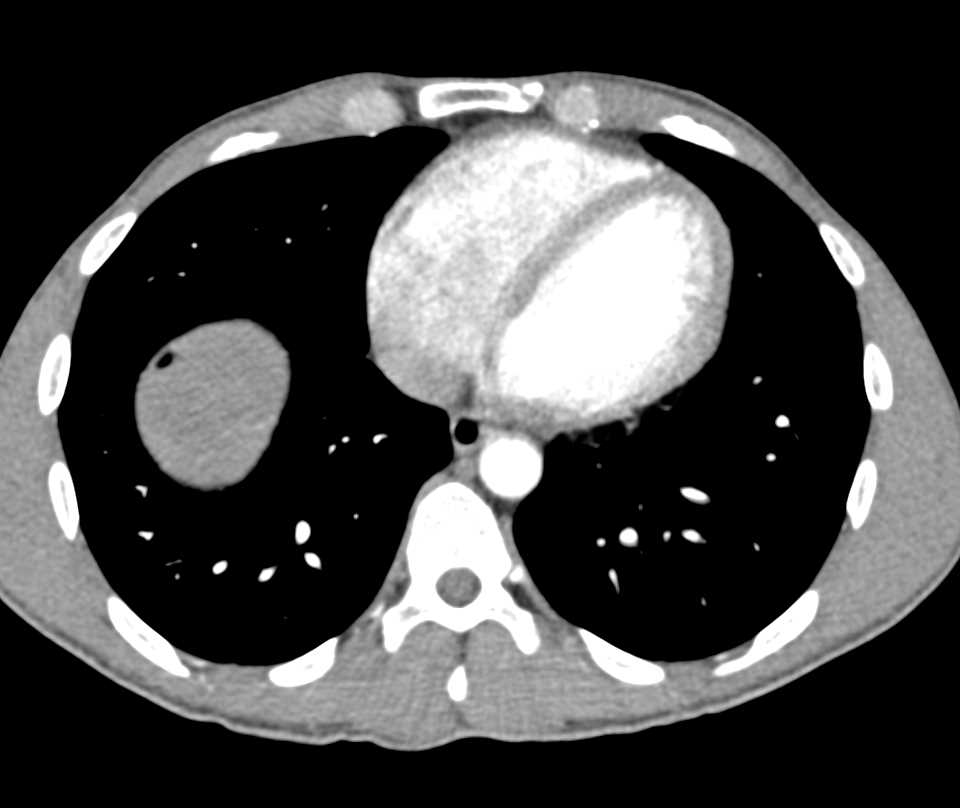 multiple liver abscesses - CTisus CT Scan