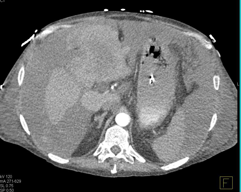 Active Bleed from Hepatocellular Carcinoma (Hepatoma) Left Lobe of the Liver with Hemoperitoneum - CTisus CT Scan