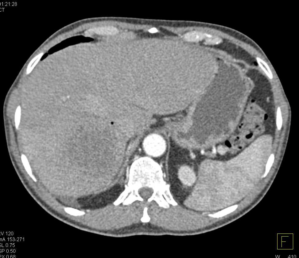 Liver Abscess - Liver Case Studies - CTisus CT Scanning