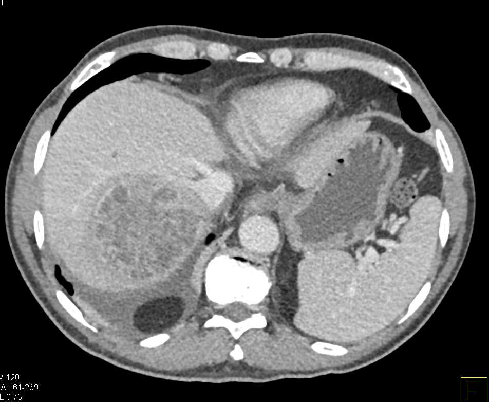 Liver Abscess - CTisus CT Scan