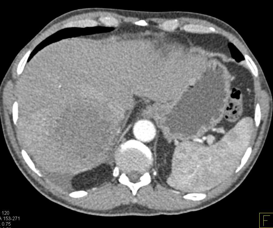 Liver Abscess - CTisus CT Scan