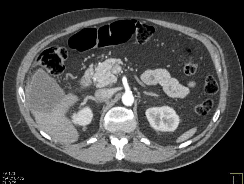 Liver Abscess - CTisus CT Scan