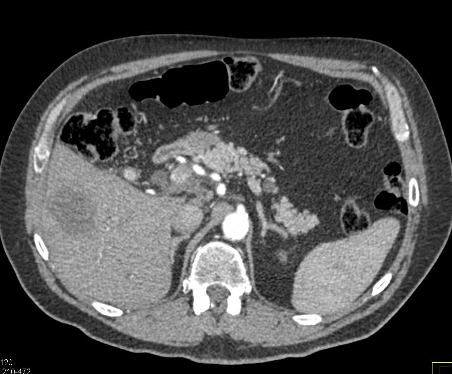 Distal Common Bile Duct (CBD) Carcinoma with Liver Metastases - CTisus CT Scan