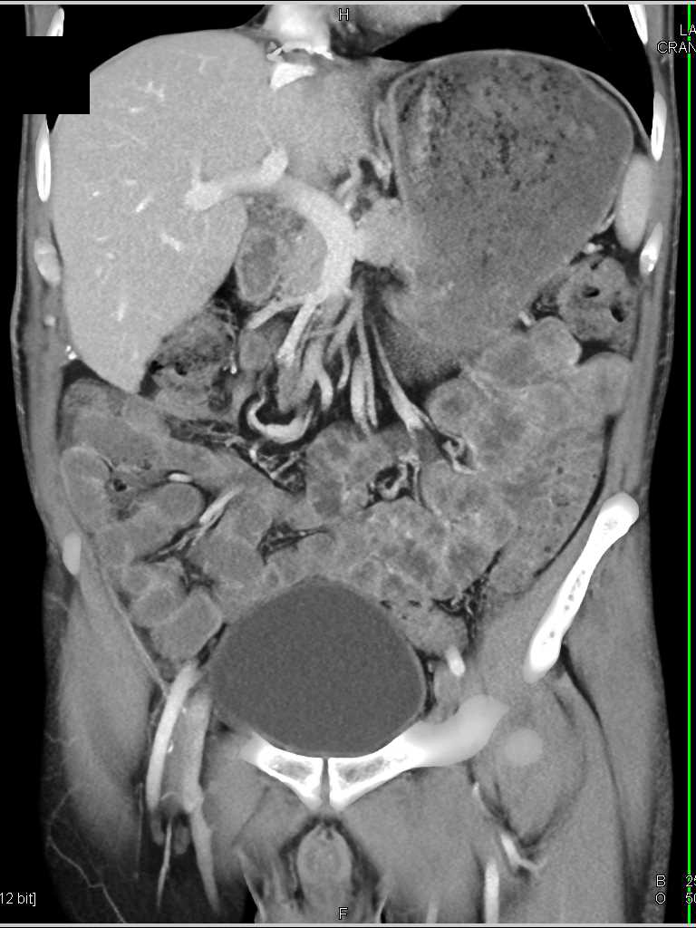 Liver Abscess - CTisus CT Scan