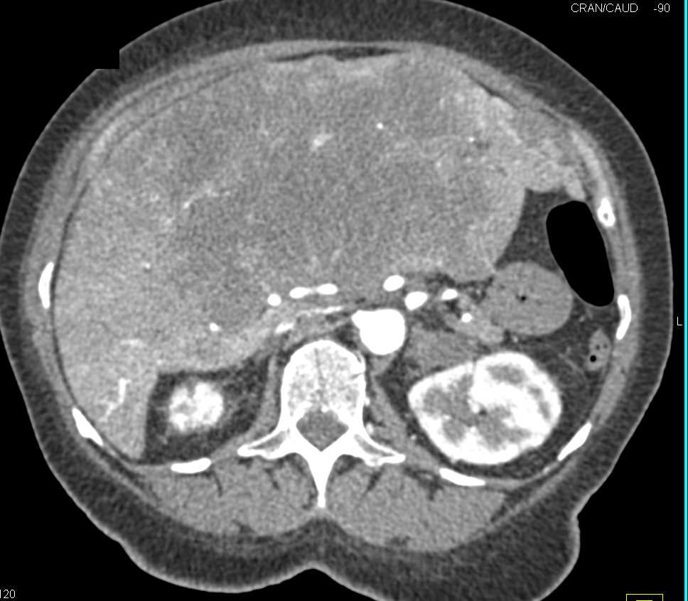 Cholangiocarcinoma Infiltrates the Liver - CTisus CT Scan