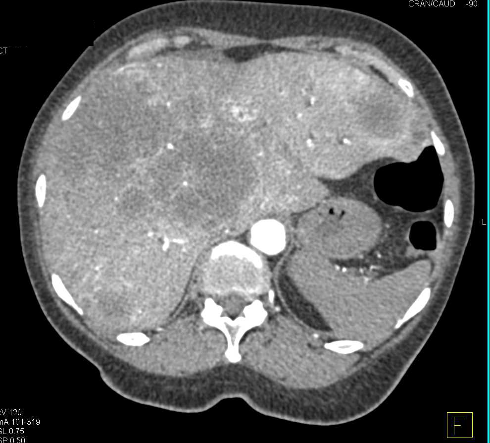 Cholangiocarcinoma Infiltrates the Liver - CTisus CT Scan