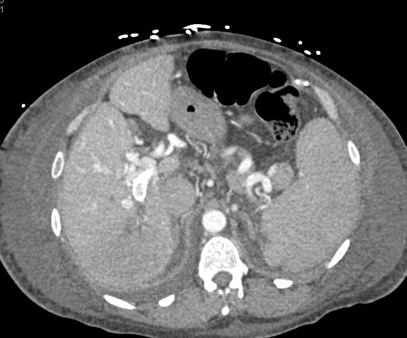 Cirrhosis with Portal Hypertension and Large Varices - CTisus CT Scan