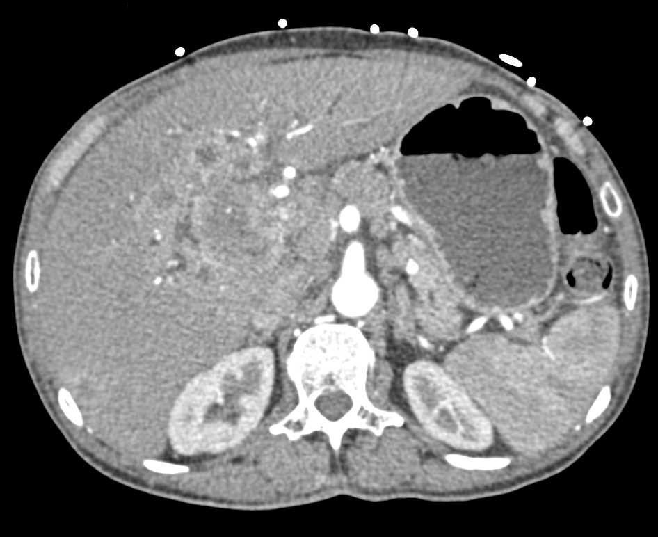 Central Cholangiocarcinoma - CTisus CT Scan