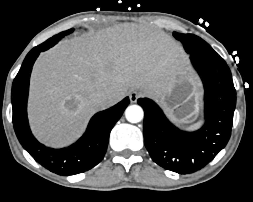 Liver Metastases and Nodes Near Porta - CTisus CT Scan