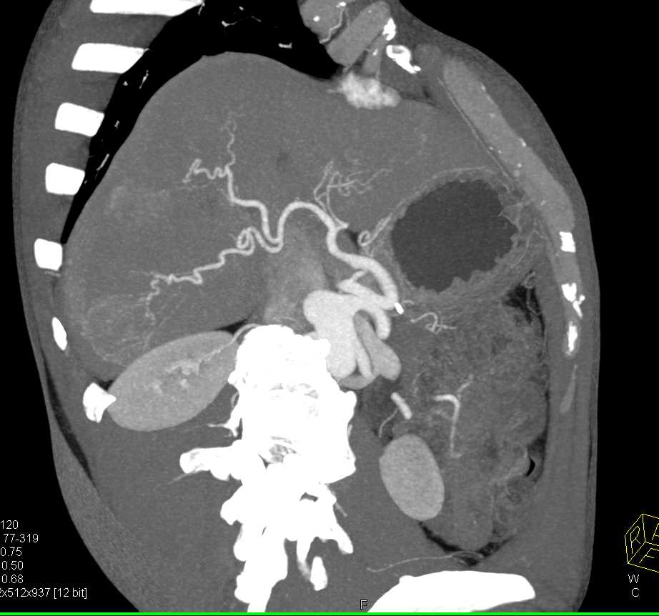 Hepatic Hemangioma on CTA - CTisus CT Scan