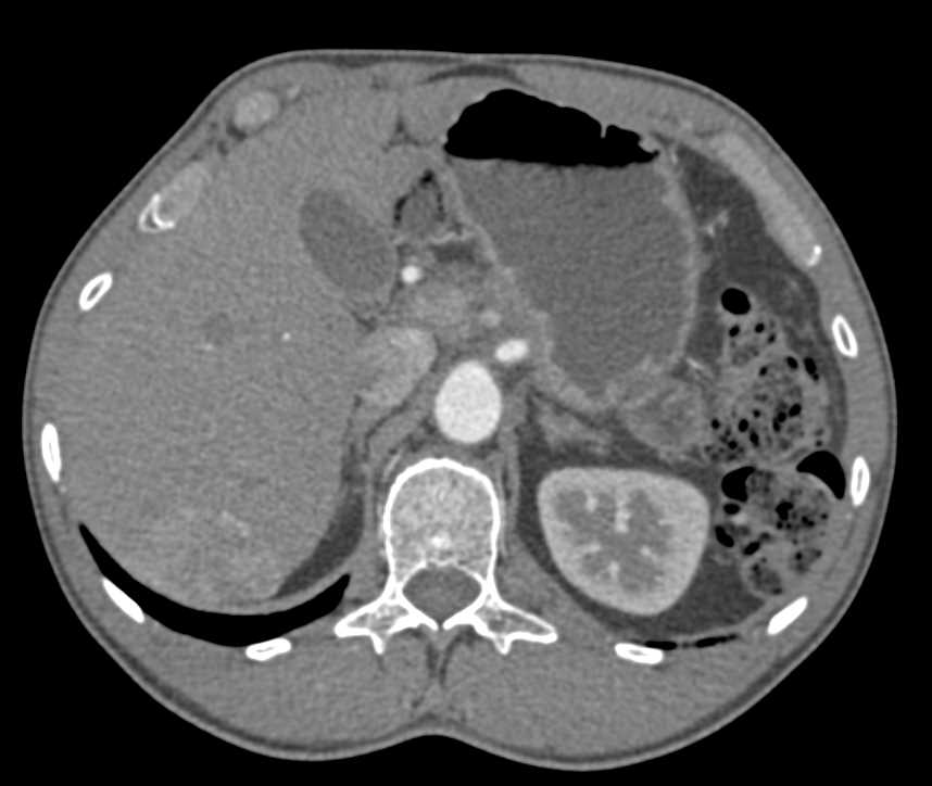 Hepatic Hemangioma on CTA - CTisus CT Scan