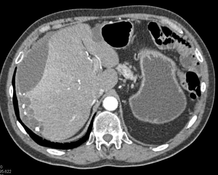 Carcinomatosis with Implants on the Liver Surface - CTisus CT Scan