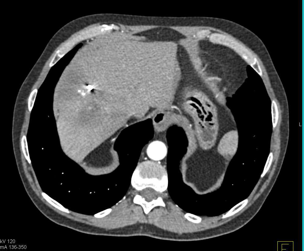 Hepatocellular Carcinoma (Hepatoma) with Multifocal Disease - CTisus CT Scan