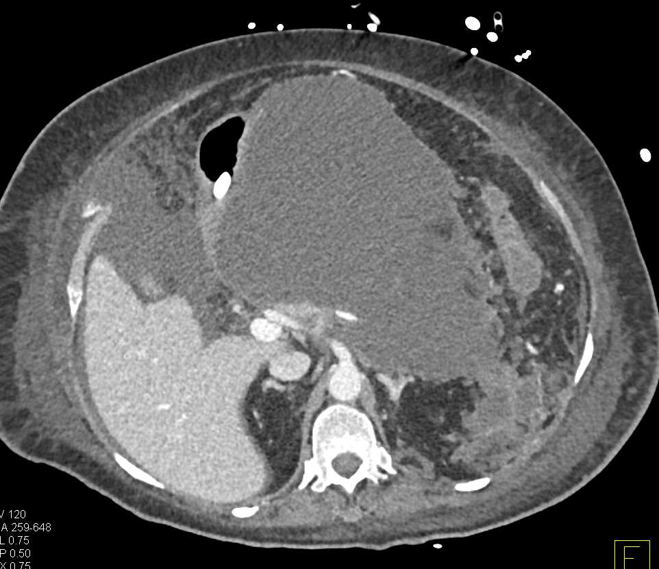 Melanoma Metastatic to the Liver - CTisus CT Scan