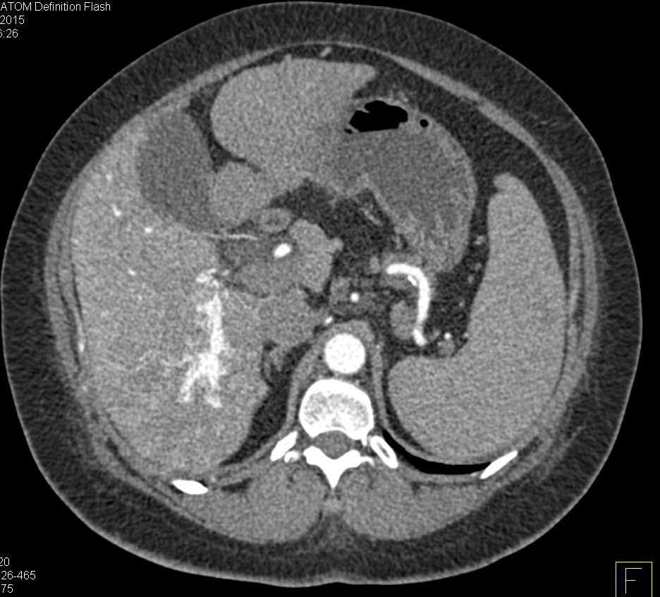 Hepatocellular Carcinoma (Hepatoma) with Arteriovenous (AV) Shunting in the Liver - CTisus CT Scan