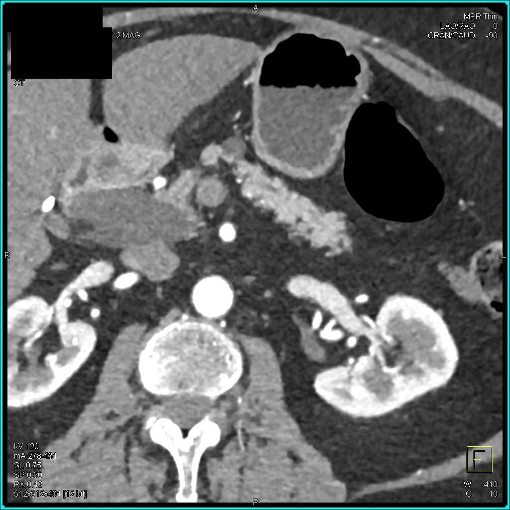 Ampullary Tumor Obstructs the Common Bile Duct (CBD) - CTisus CT Scan