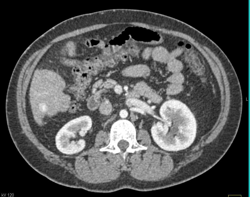 Ampullary Carcinoma with Stent in Common Bile Duct (CBD) - CTisus CT Scan