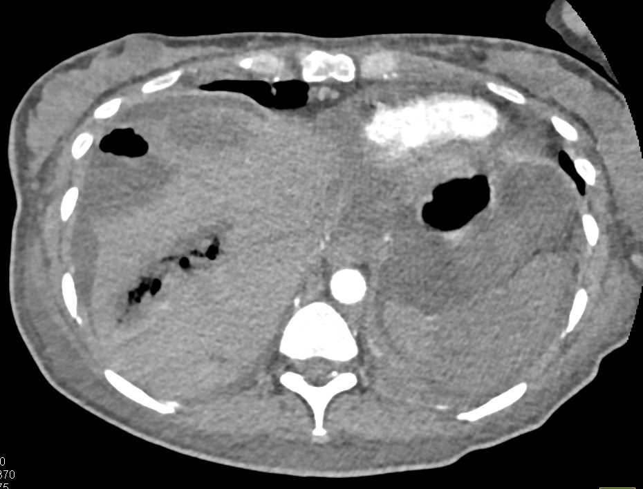 Multiple Liver Abscesses - CTisus CT Scan