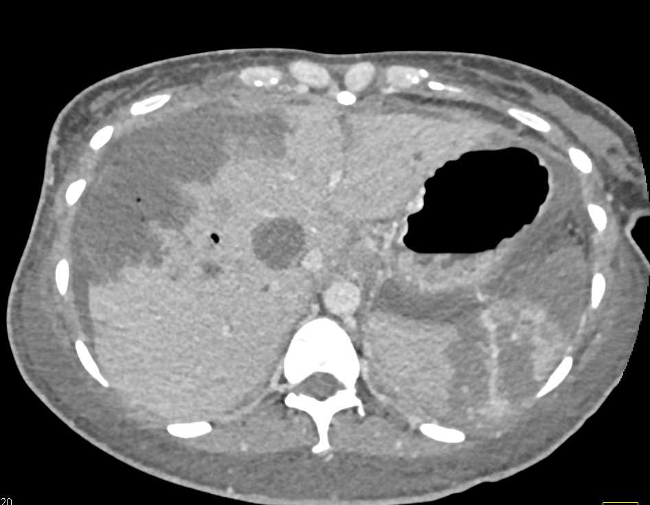 Multiple Liver and Splenic Infarcts - CTisus CT Scan