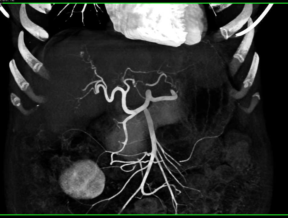 1 cm Hepatocellular Carcinoma (Hepatoma) in Cirrhotic Liver with Neovascularity - CTisus CT Scan