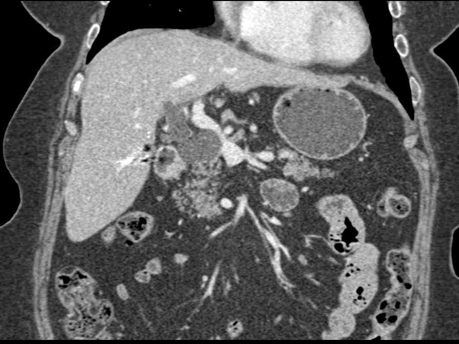 Cystic Lesion off the Common Bile Duct - CTisus CT Scan