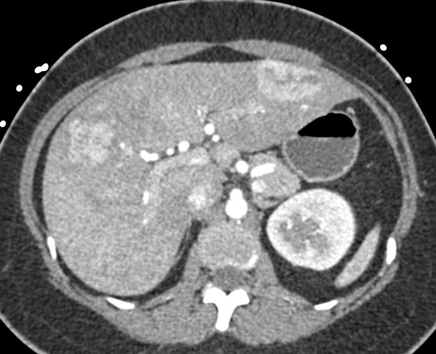 Hepatic Adenoma with Spontaneous Bleed - CTisus CT Scan