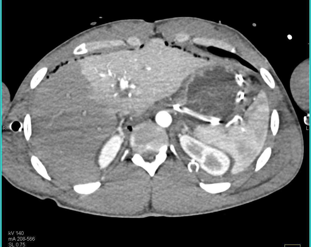 Hepatic Infarction s/p Trauma - Liver Case Studies - CTisus CT Scanning