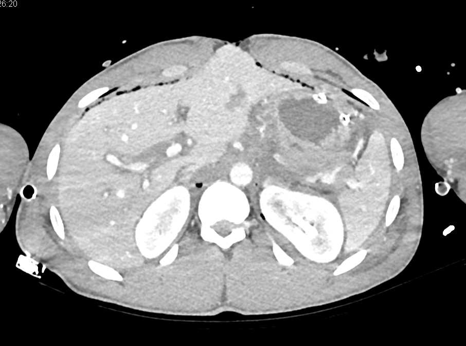 Hepatic Infarction s/p Trauma - CTisus CT Scan