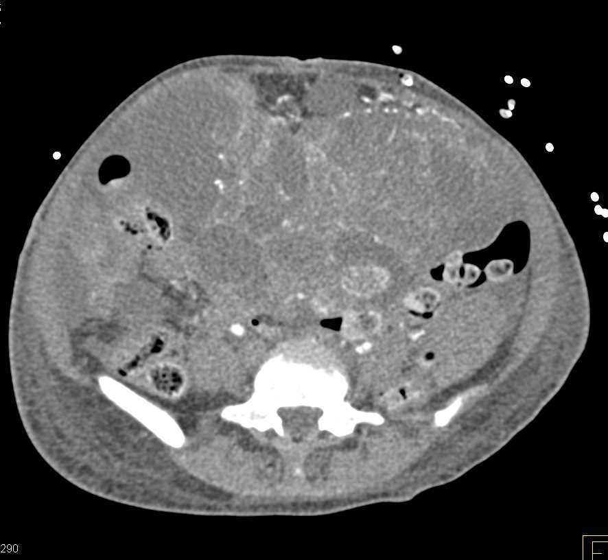 Multifocal Hepatocellular Carcinoma (Hepatoma) with Metastases to the Abdomen - CTisus CT Scan