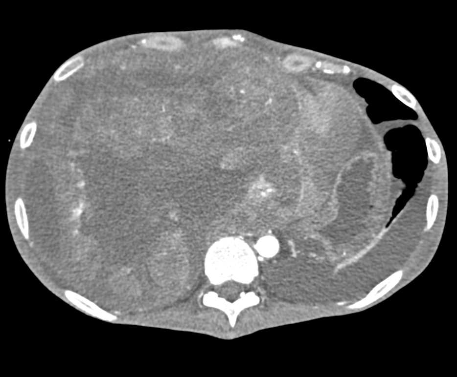 Extensive Tumor in Liver due to Hepatocellular Carcinoma (Hepatoma) With Subsequent TACE - CTisus CT Scan