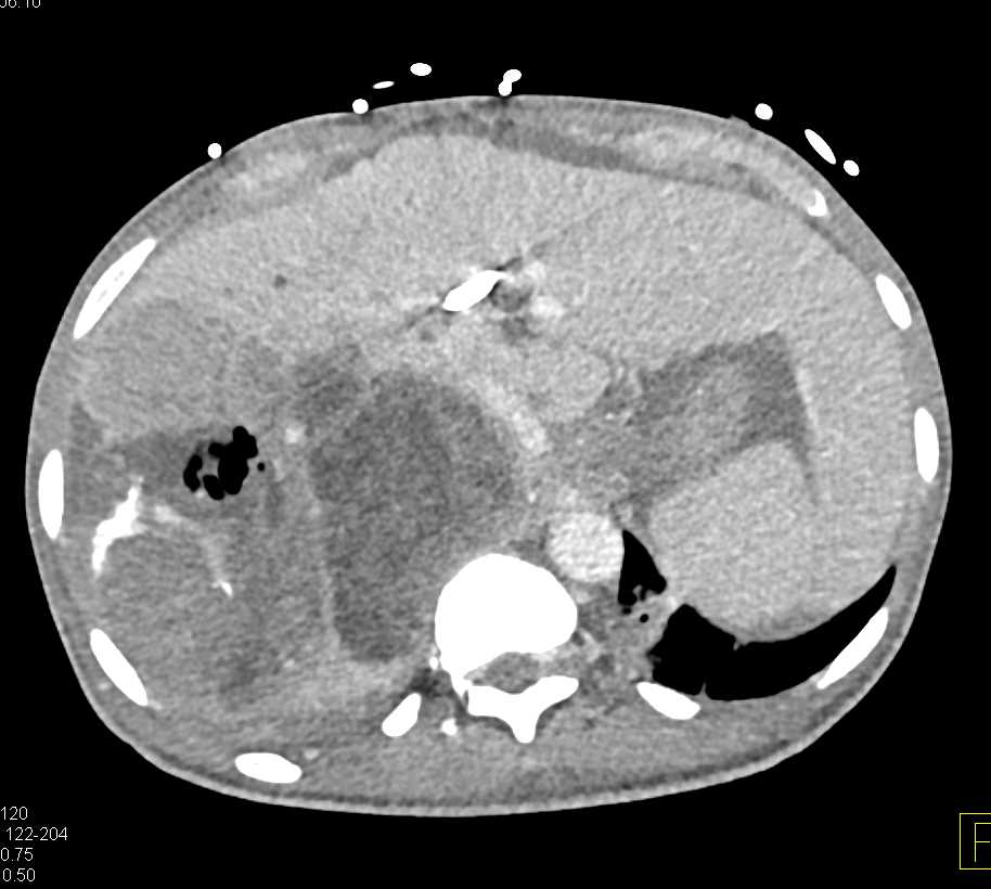 Necrotic Liver Tumor S/P TACE Procedure with Abscess Developing in Time - CTisus CT Scan