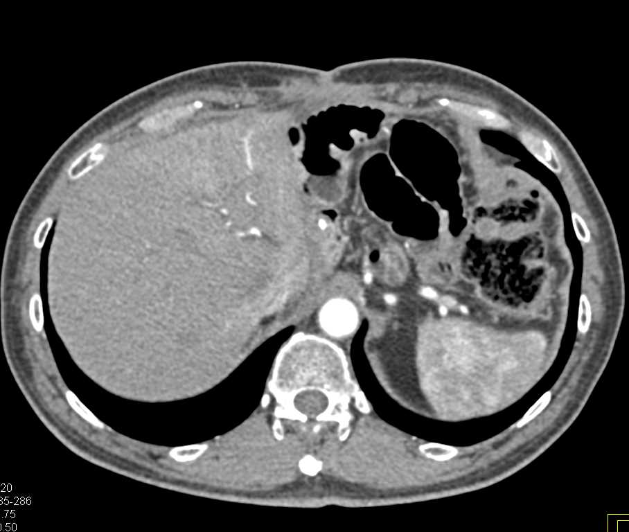 Subtle Liver Metastases s/p Whipple Procedure - CTisus CT Scan