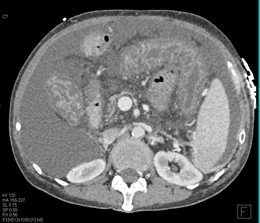 Cirrhosis with Hypoproteinemia - CTisus CT Scan