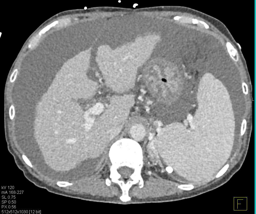 Liver Cirrhosis Ct Scan