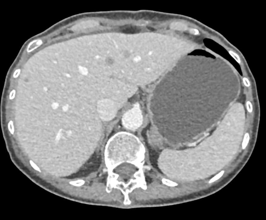 Diffuse Liver Metastases - CTisus CT Scan