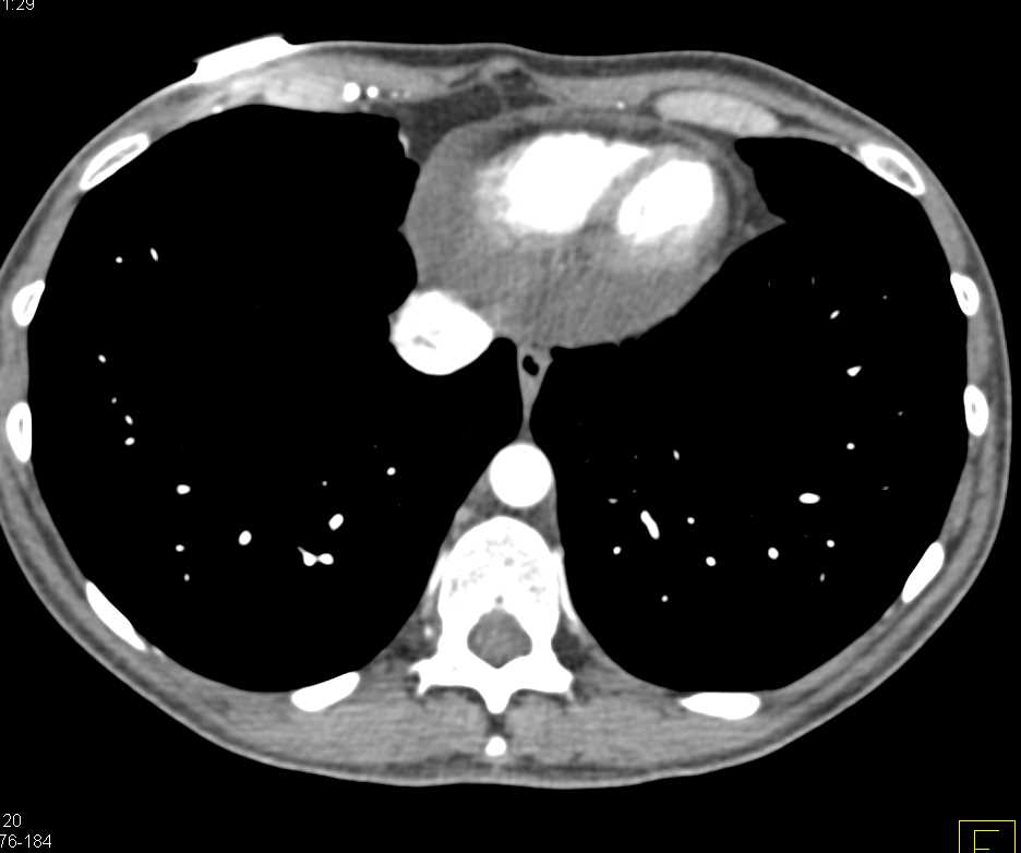 Congested Liver in Patient with a Pericardial Effusion - CTisus CT Scan