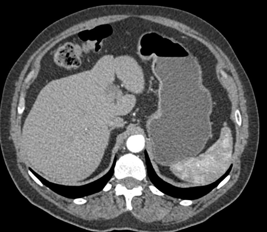 Focal Fat Simulates and Adrenal Lesion - CTisus CT Scan