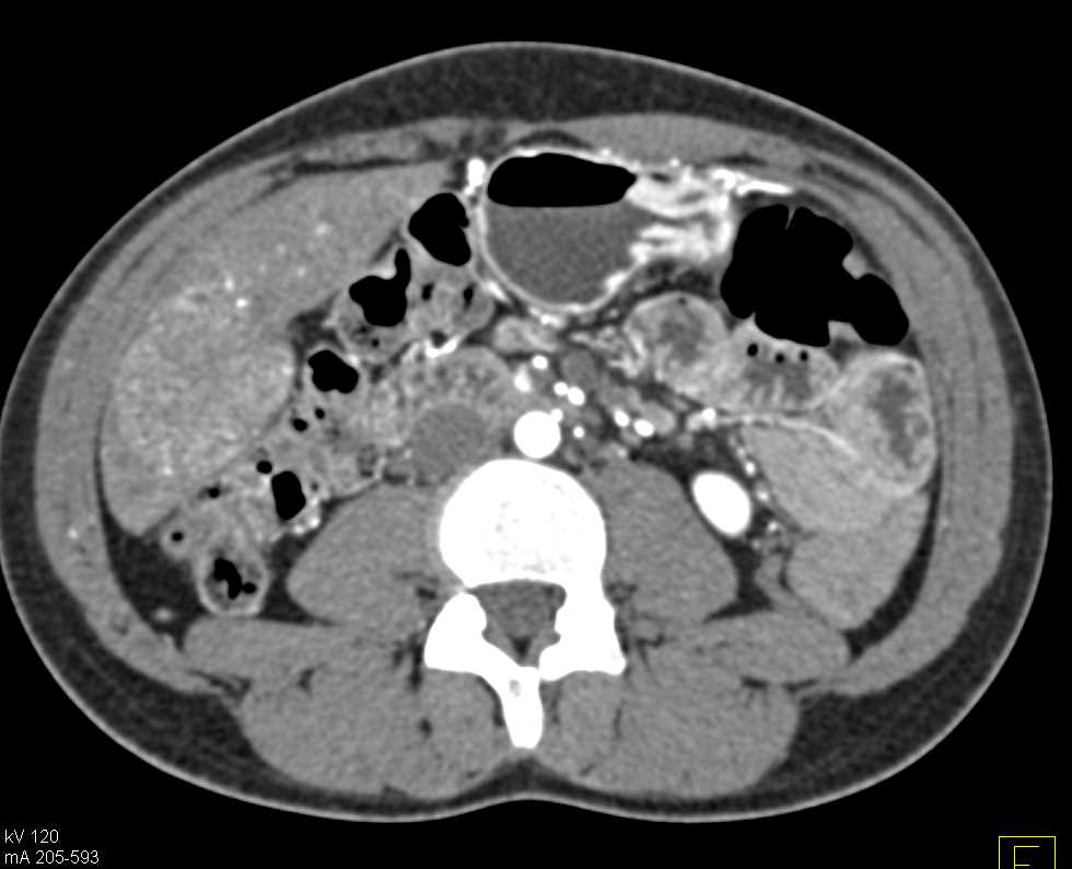 Hepatic Adenoma in the Right Lobe of the Liver - CTisus CT Scan