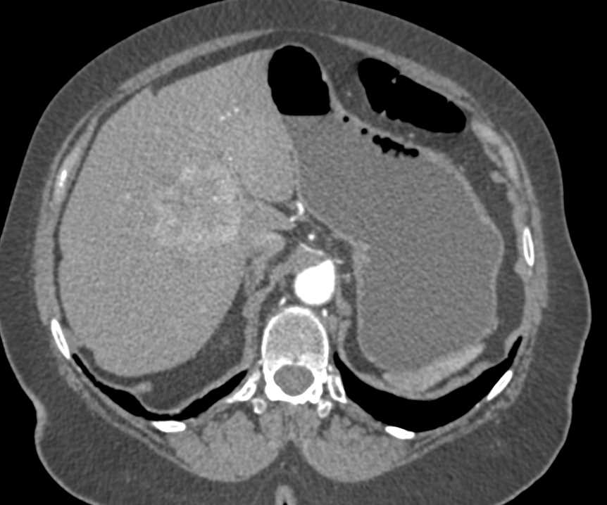 Central Cholangiocarcinoma of the Liver - CTisus CT Scan